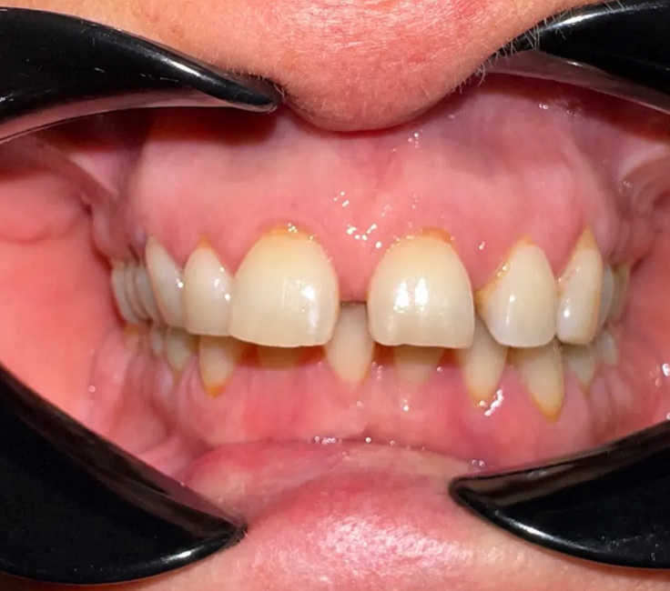 <span class="bt_bb_before_after_image_before_text">Öncesi</span>