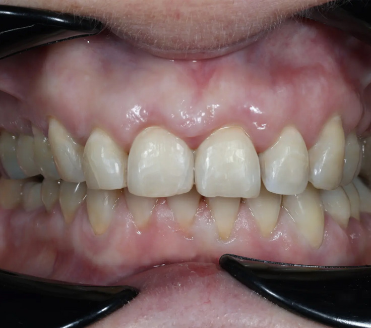 <span class="bt_bb_before_after_image_after_text">Sonrası</span>